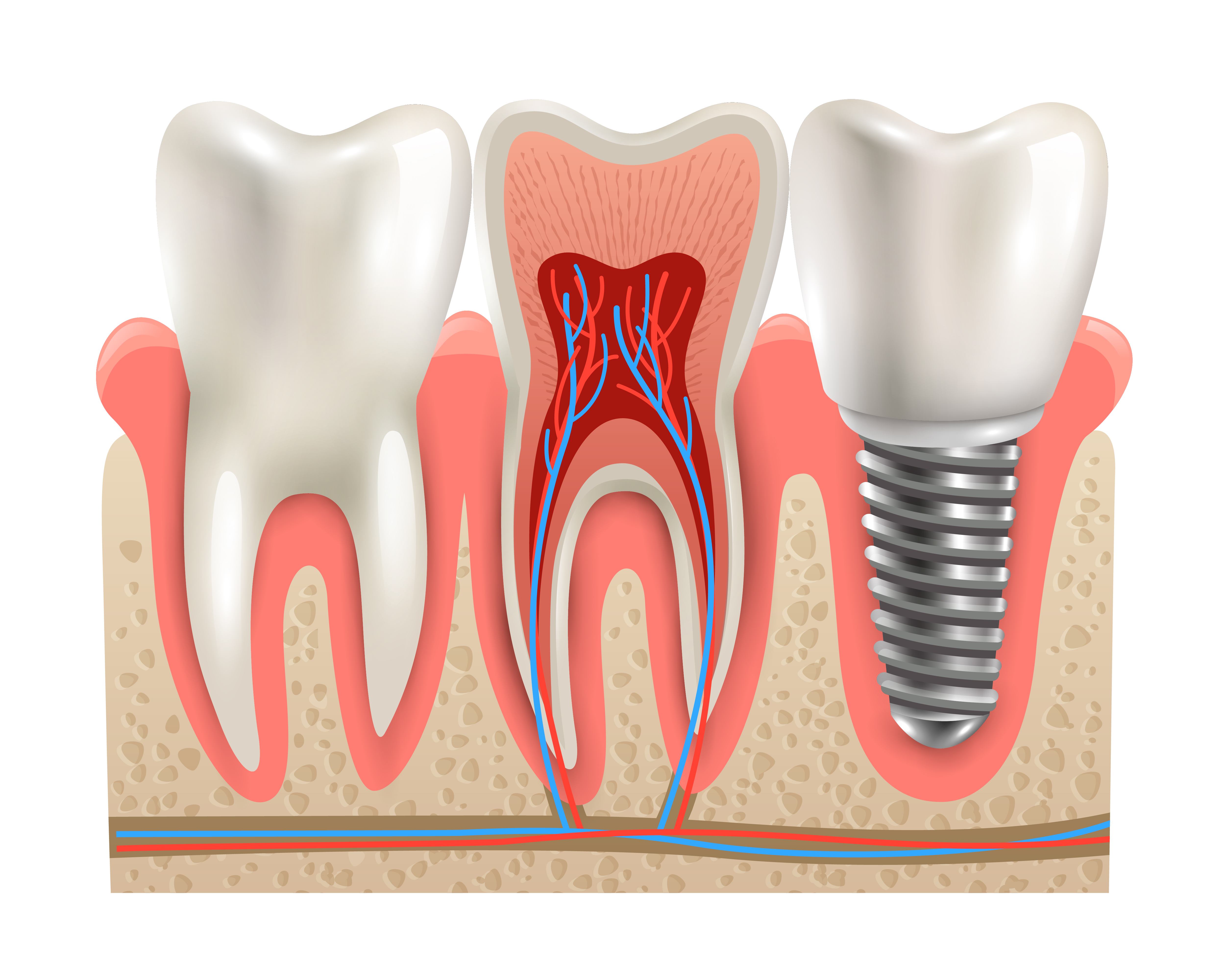 Best veneers teeth in Surat